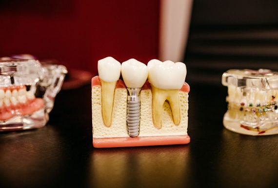 Dental Implants